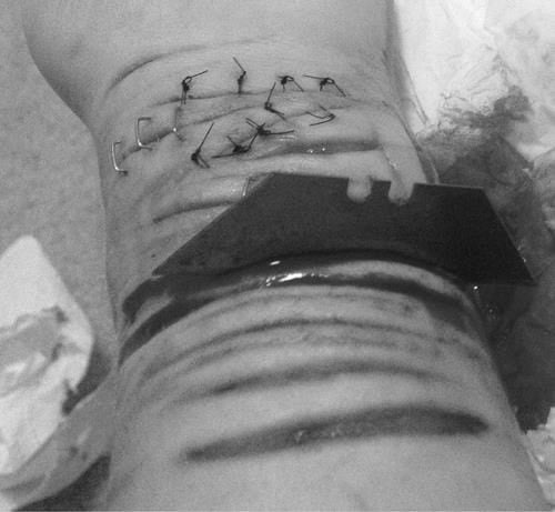 MIMADA - ADOLESCENTE CORTA OS PULSOS APÓS MÃE PROIBIR NAMORADO NA RESIDÊNCIA - News Rondônia