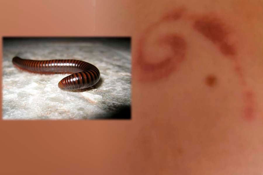 PIOLHO DE COBRA - Adolescente de Rondônia acorda com mancha no rosto - News Rondônia