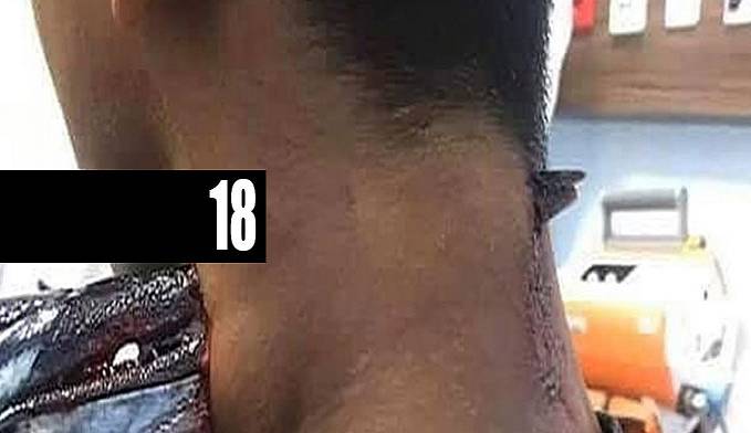 IMAGEM FORTE: JOVEM TEM PESCOÇO E PARTE DO CRÂNIO PERFURADOS POR PEIXE-AGULHA - News Rondônia