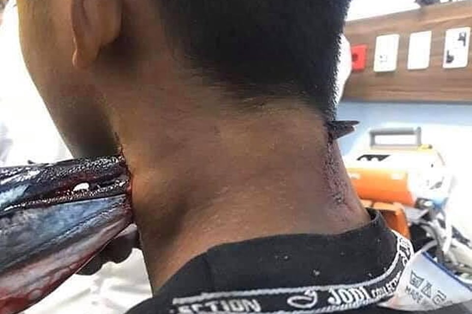 IMAGEM FORTE: JOVEM TEM PESCOÇO E PARTE DO CRÂNIO PERFURADOS POR PEIXE-AGULHA - News Rondônia