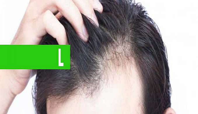 CALVÍCIE X QUEDA DE CABELO - News Rondônia