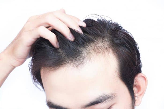 CALVÍCIE X QUEDA DE CABELO - News Rondônia