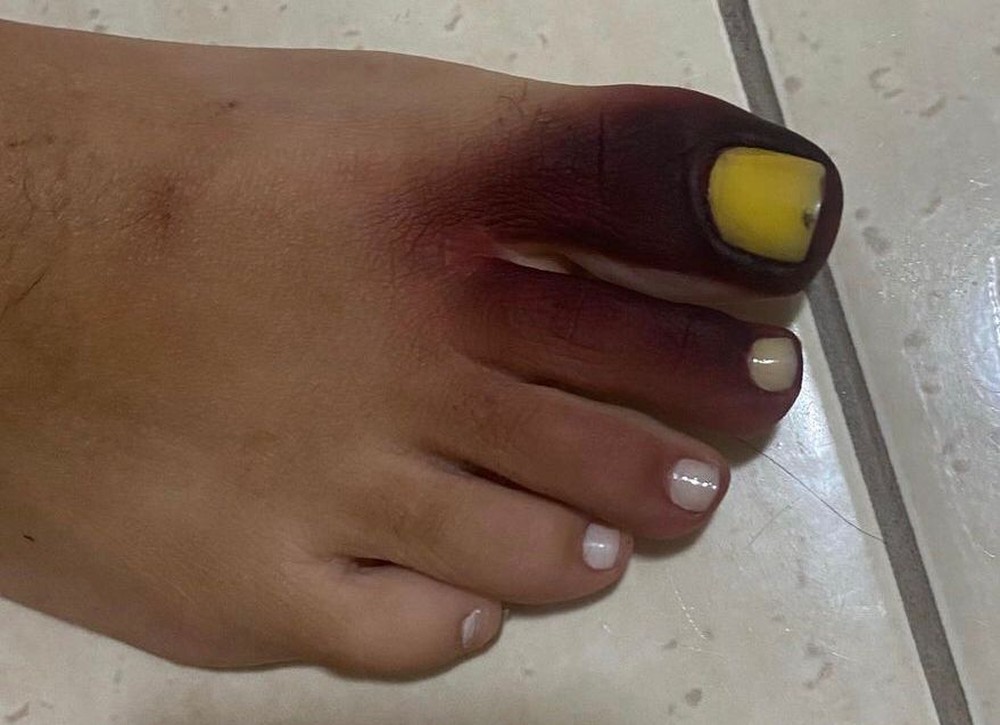 Após calçar tênis com piolho-de-cobra, empresária fica com pé roxo e unha amarela - News Rondônia