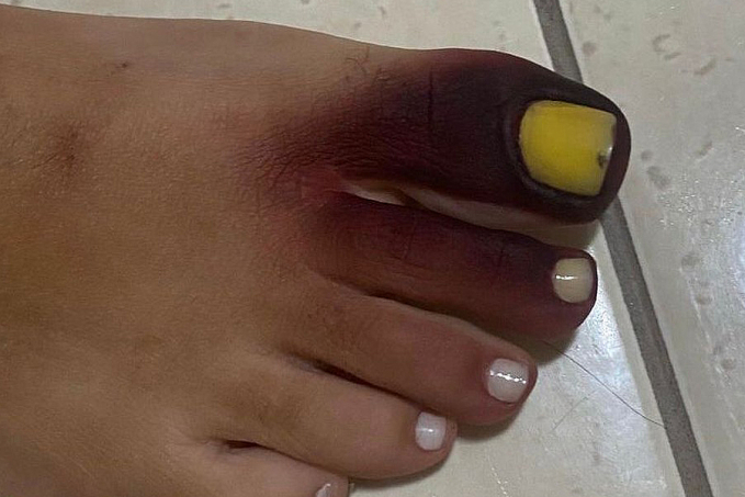 Após calçar tênis com piolho-de-cobra, empresária fica com pé roxo e unha amarela - News Rondônia