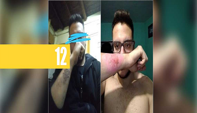 JOVEM FAZ TATUAGEM, SE ARREPENDE E A REMOVE COM RALADOR - News Rondônia