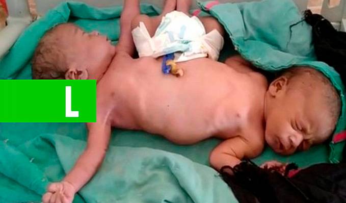 IMPRESSIONANTE: Gêmeas siamesas nascem com duas pernas e quatro braços e desafiam médicos - News Rondônia