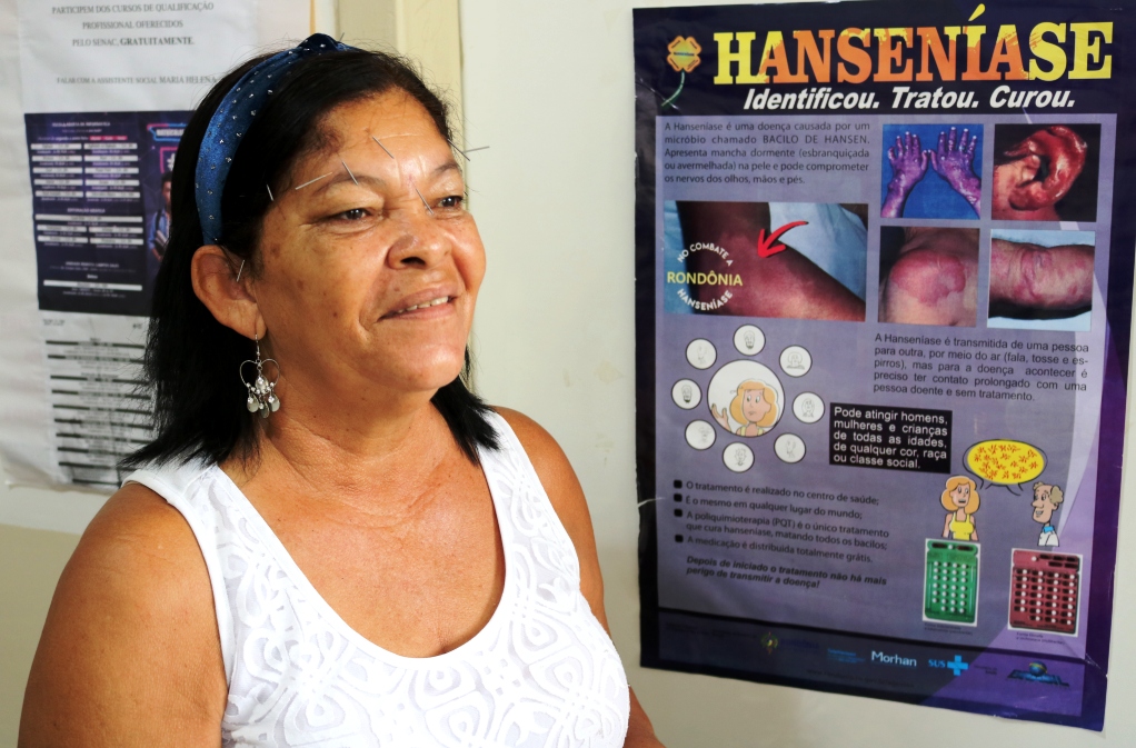 AMBULATÓRIO DE REFERÊNCIA ESTADUAL EM HANSENÍASE REALIZA CERCA DE 400 ATENDIMENTOS POR MÊS - News Rondônia