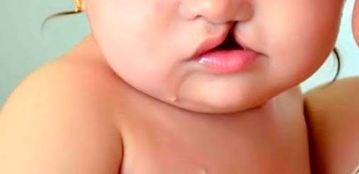 FISSURA LABIOPALATINA: Hospital devolve sorrisos aos pacientes com lábio leporino e realiza mutirão de cirurgias reparadoras - News Rondônia
