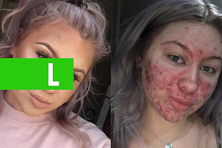 JOVEM QUE SE MAQUIAVA POR 2 HORAS PARA ESCONDER ACNE NO ROSTO, DECIDE SE ACEITAR COMO É - News Rondônia