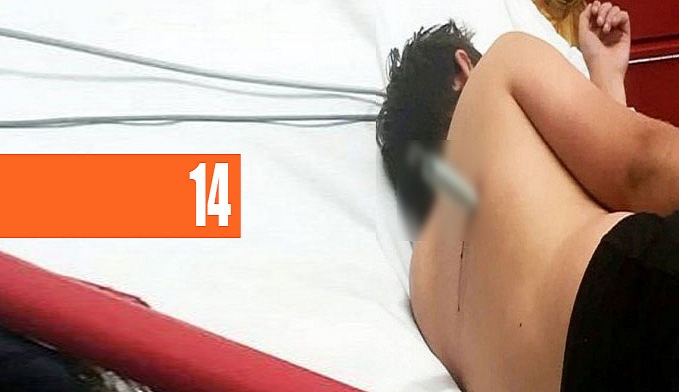 ADOLESCENTE FICA COM MOLA CRAVADA NAS COSTAS APÓS DEFEITO EM CAMA ELÁSTICA (IMAGEM FORTE) - News Rondônia