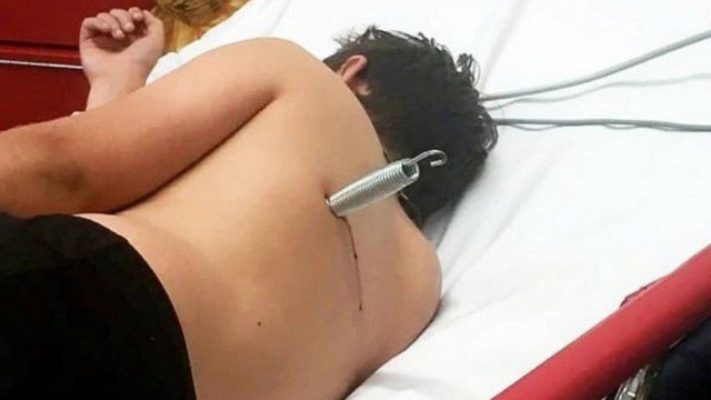 ADOLESCENTE FICA COM MOLA CRAVADA NAS COSTAS APÓS DEFEITO EM CAMA ELÁSTICA (IMAGEM FORTE) - News Rondônia