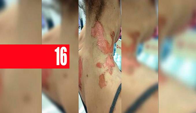 "Pensei que iria morrer", diz mulher trans queimada por funcionário do Itamaraty - News Rondônia