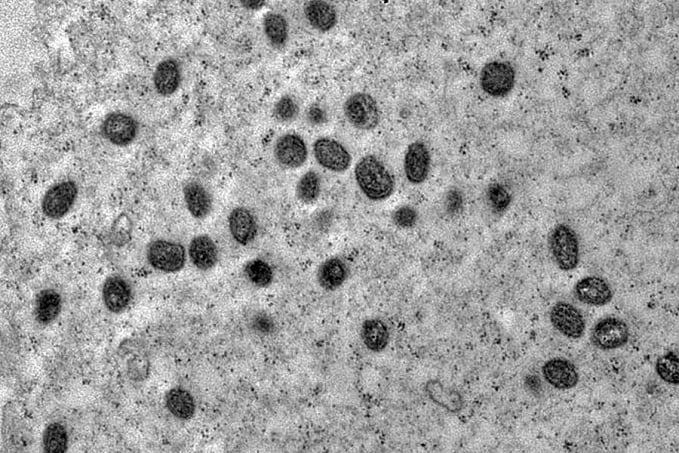 Pesquisa indica risco de monkeypox agravar infeccão por HIV - News Rondônia
