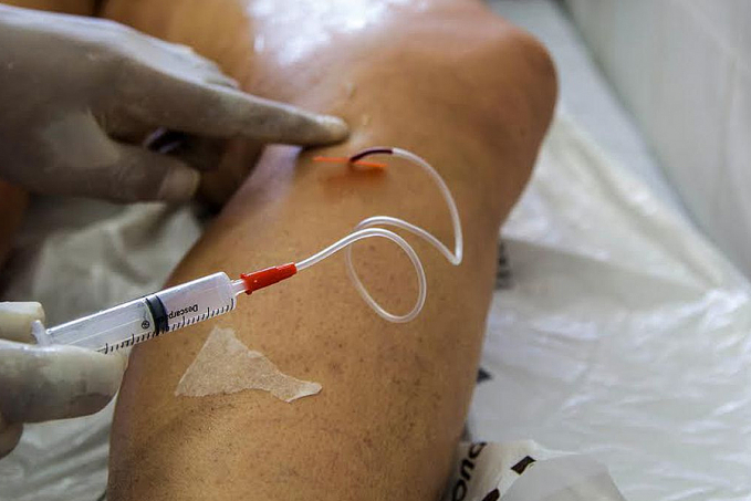 Pandemia fez cirurgias de varizes pelo SUS despencarem 69% no país - News Rondônia