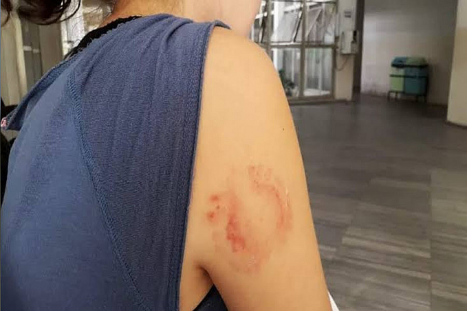 ALTERADO: Marido esfaqueia, morde e ameaça matar mulher carbonizada - News Rondônia