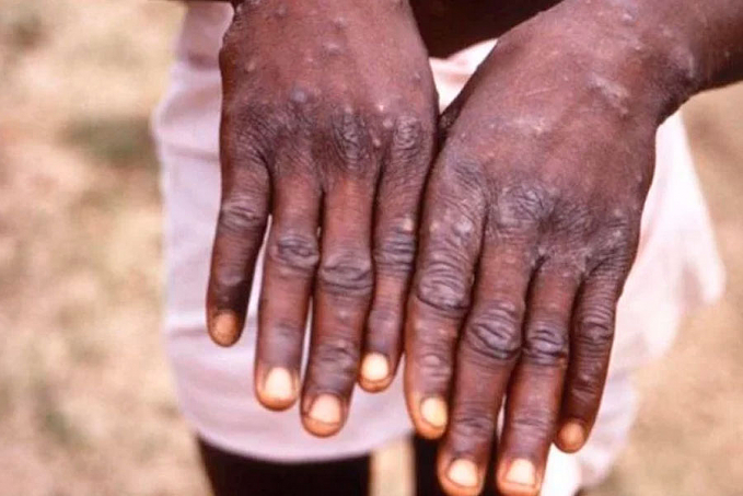 Saiba o que é Mpox: Casos da varíola dos macacos preocupam autoridades de saúde em vários países - News Rondônia