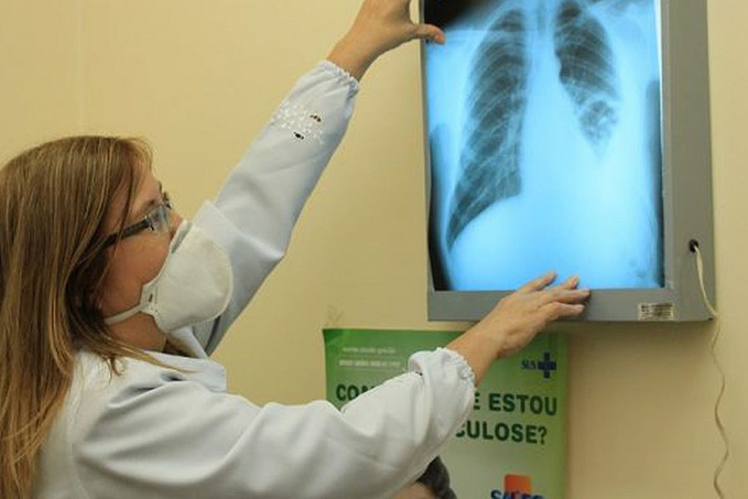 Conselho aprova novas diretrizes para tratamento da tuberculose no SUS - News Rondônia