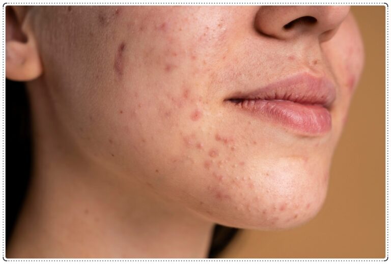 As principais diferenças entre a foliculite e a acne: saiba como identificar cada uma - News Rondônia