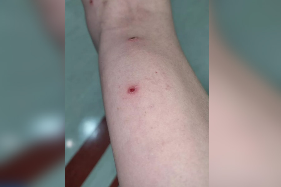 'Já contei 60 feridas, mas estou ótimo, diz brasileiro diagnosticado com varíola dos macacos - News Rondônia