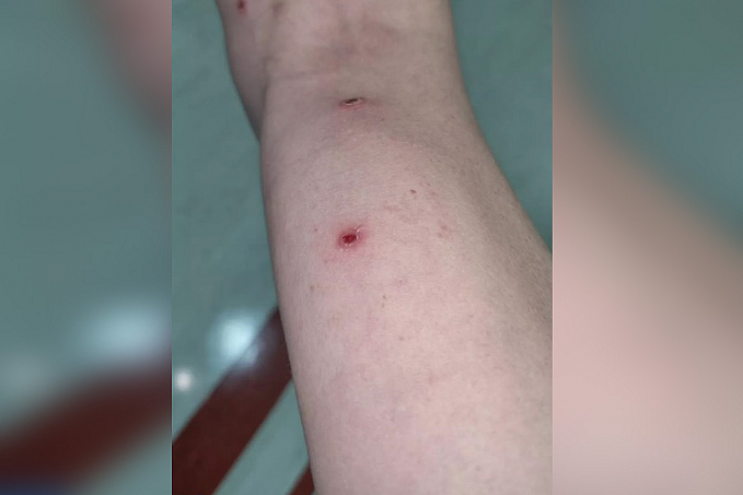 'Já contei 60 feridas, mas estou ótimo, diz brasileiro diagnosticado com varíola dos macacos - News Rondônia