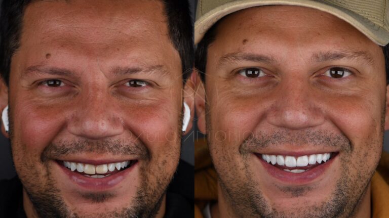 Após vencer reality, Thiago Servo muda o visual e investe R$ 30 mil em lentes de contato dental e clareamento