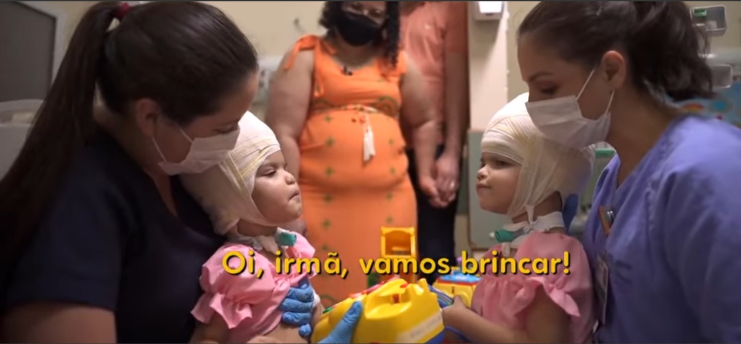 Pela 1ª vez após separadas, gêmeas siamesas ficam frente a frente: “vamos brincar?”