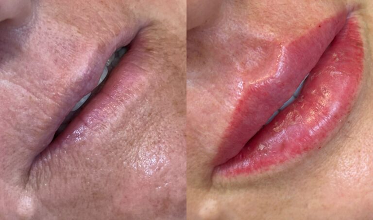 Preenchimento labial na terceira: rejuvenescimento imediato
