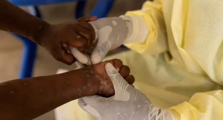 Mpox: OMS pede resposta após registro de nova variante na Suécia