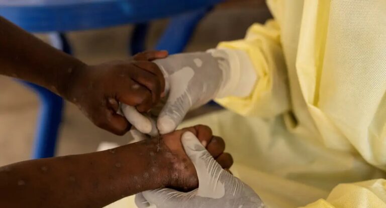 RDC espera receber primeiras vacinas contra mpox até próxima semana