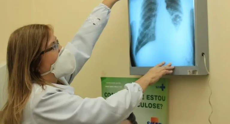 Brasil está na contramão da meta da OMS para extinção da tuberculose