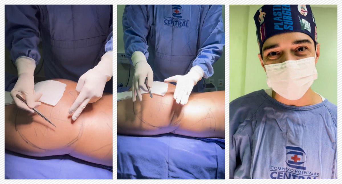 A evolução da lipoescultura: tecnologia avançada e resultados naturais - News Rondônia