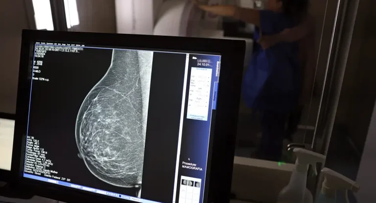 AGU processa médico por alegação falsa sobre mamografia