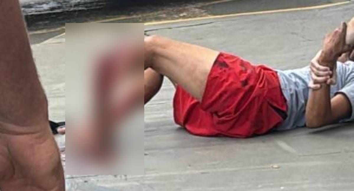 Mulher sofre fratura exposta ao colidir com poste após manobra para evitar caminhão
