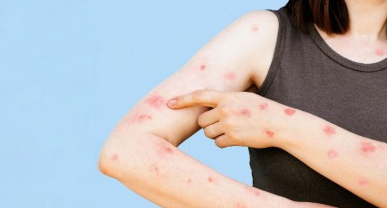 Mpox: no Amazonas, casos confirmados colocam o estado em alerta - News Rondônia