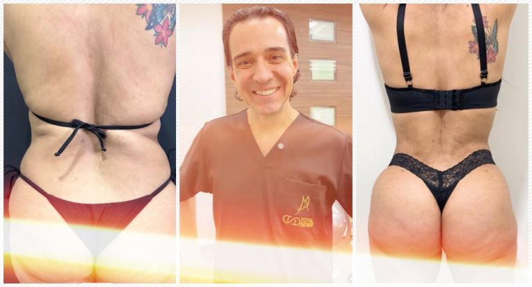 Bumbum pequeno e flácido: isso tem solução com Dr. Marcelo Almeida - News Rondônia