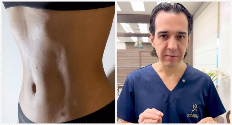 Abdominoplastia com cicatriz discreta e sem corte no umbigo? Com Dr. Marcelo Almeida, isso é possível - News Rondônia