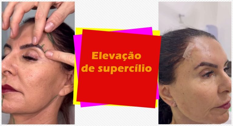 Elevação de supercílio: descubra como rejuvenescer o olhar sem cirurgia complexa - News Rondônia