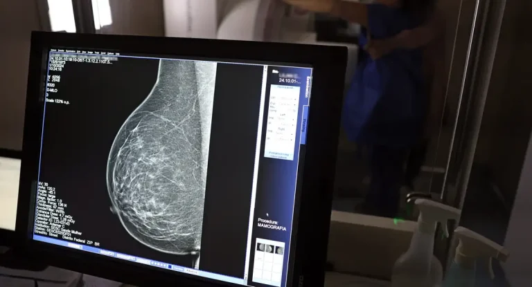 Câncer de mama atinge mais de 108 mil mulheres abaixo de 50 anos no Brasil entre 2018 e 2023