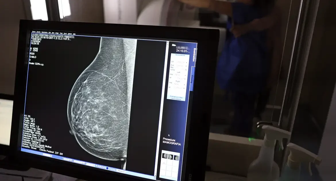 Câncer de mama atinge mais de 108 mil mulheres abaixo de 50 anos no Brasil entre 2018 e 2023