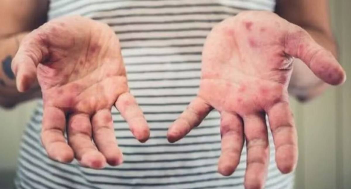 Agevisa investiga caso suspeito de Sarampo em Rondônia e emite alerta