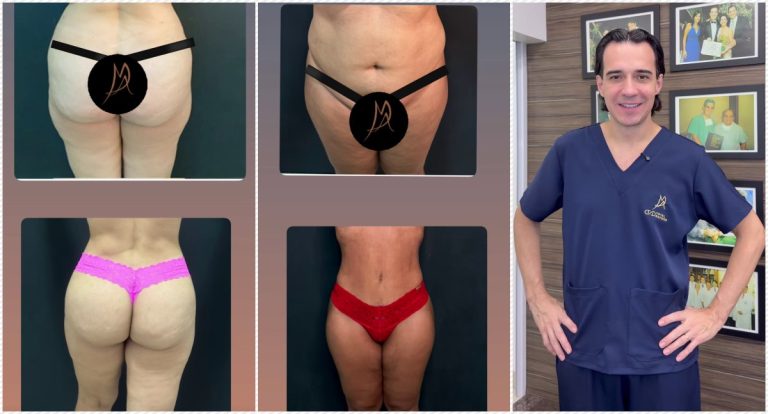 Tratamento de lipedema com técnicas exclusivas transforma a vida de pacientes na Clínica Marcelo Almeida
