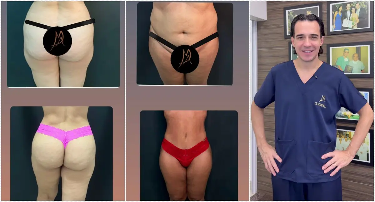 Tratamento de lipedema com técnicas exclusivas transforma a vida de pacientes na Clínica Marcelo Almeida