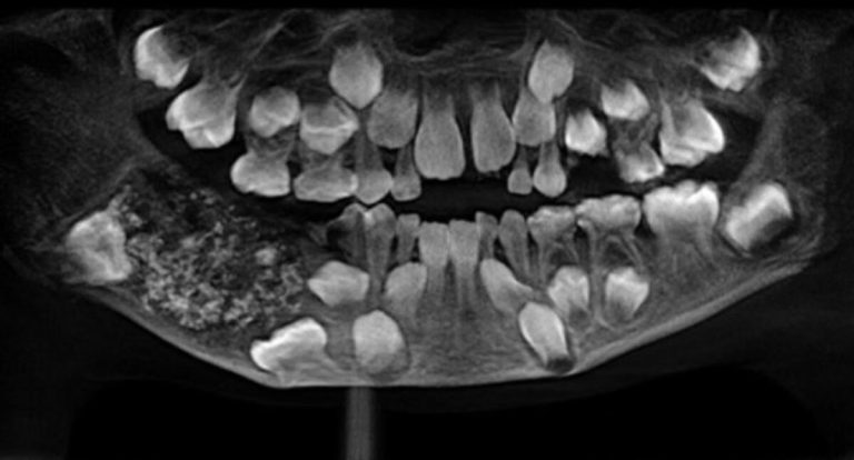 Menino de 7 anos passa por cirurgia na Índia e tem 526 dentes removidos - News Rondônia