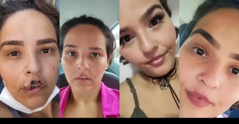 Mulher atacada por chow-chow em Rondônia celebra 2ª cirurgia reparadora: “Minha alegria voltou” - News Rondônia