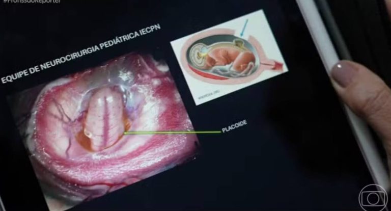 Cirurgia inédita do SUS corrige coluna de bebê antes do nascimento