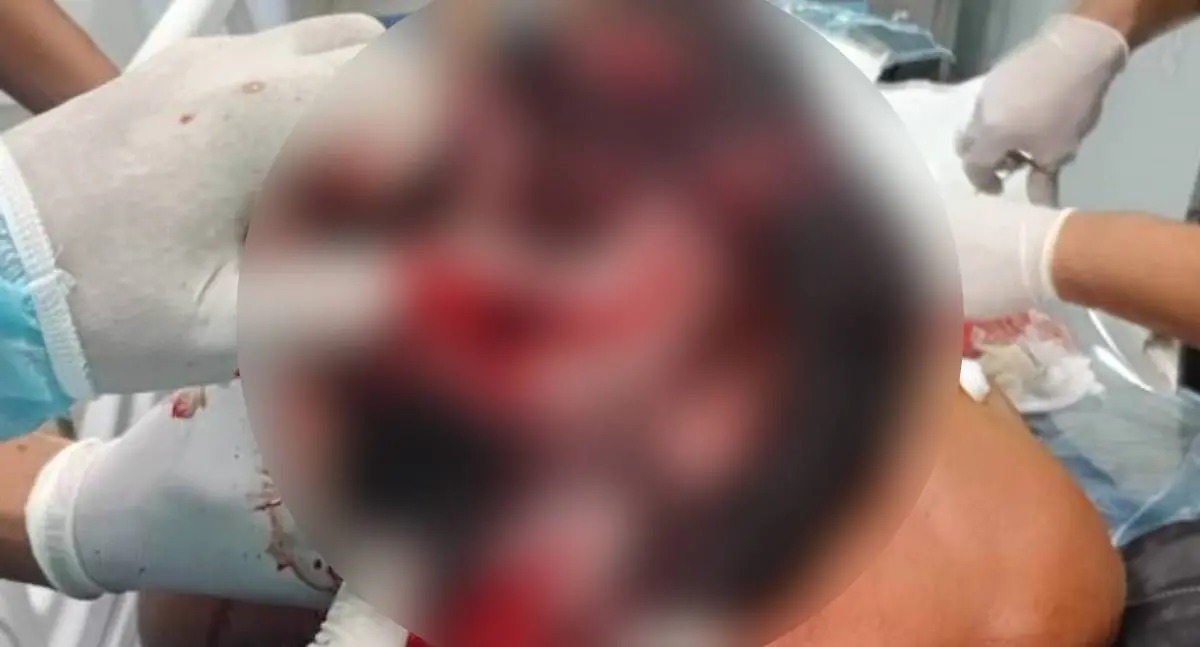 Imagens de cacique "esfolado" após ataque de onça viralizam