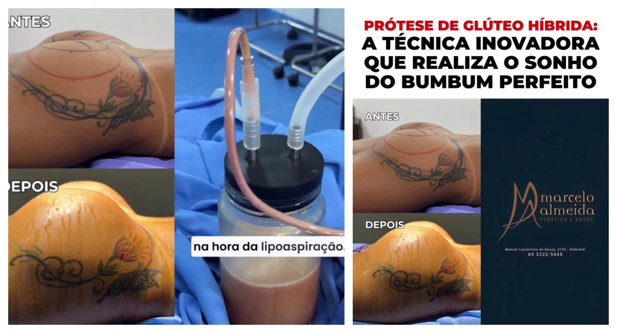 De acordo com o Dr. Marcelo Almeida, a prótese glútea híbrida apresenta vantagens em relação aos procedimentos tradicionais: