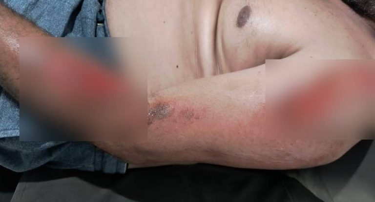 Homem fica ferido após cair em quebra-molas sem sinalização