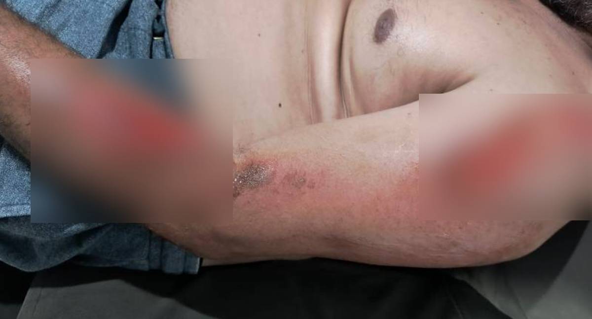 Homem fica ferido após cair em quebra-molas sem sinalização