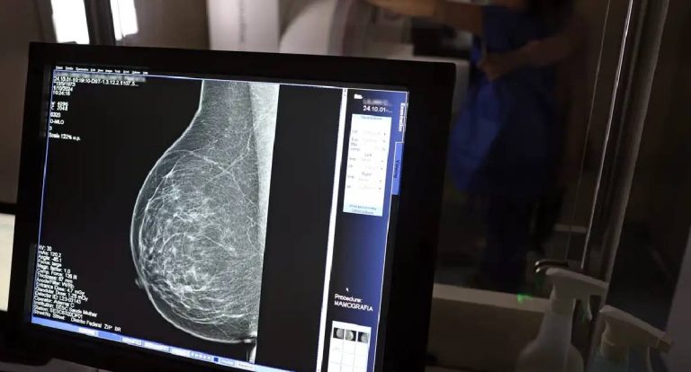 Ministério da Saúde muda e recomenda mamografia aos 40 anos